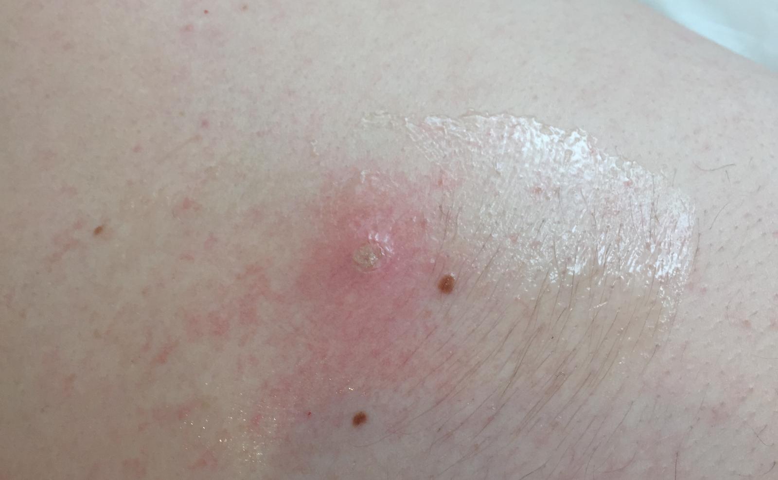 skin tag after treatment