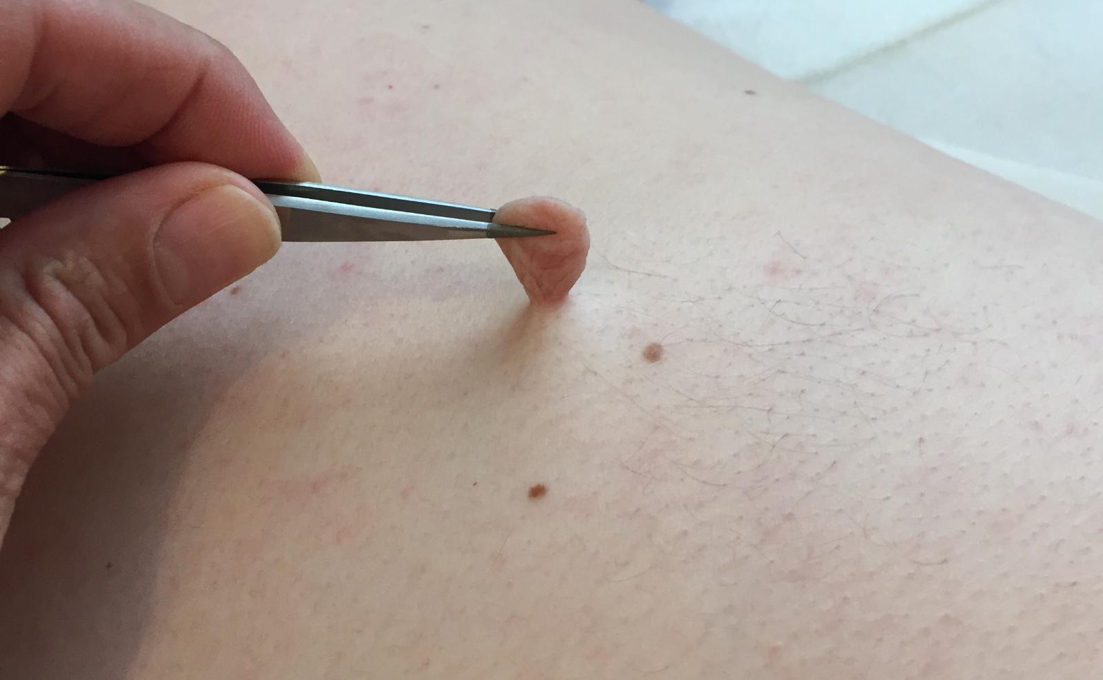 Skin Tags and Sebaceous Cyst Removal