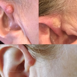 mole removal ear