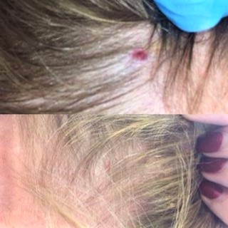 before and after angioma treatment