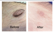 wart before and after treatment