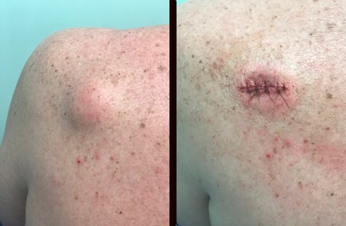 serbaceous cyst on back
