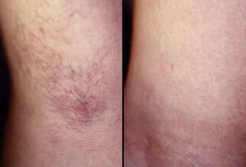 thread vein treatment with scleretherapy