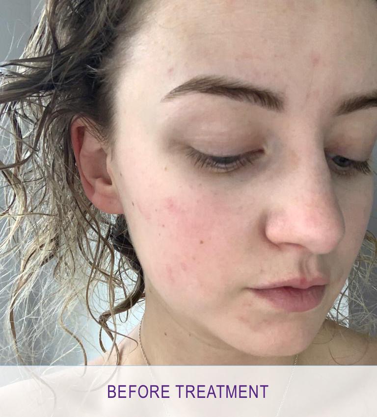 lumispa blemish prone